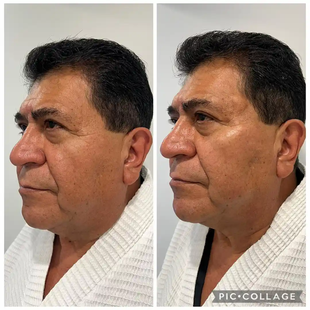 Antes y después de tratamiento con bioestimuladores — Alberto Ramírez